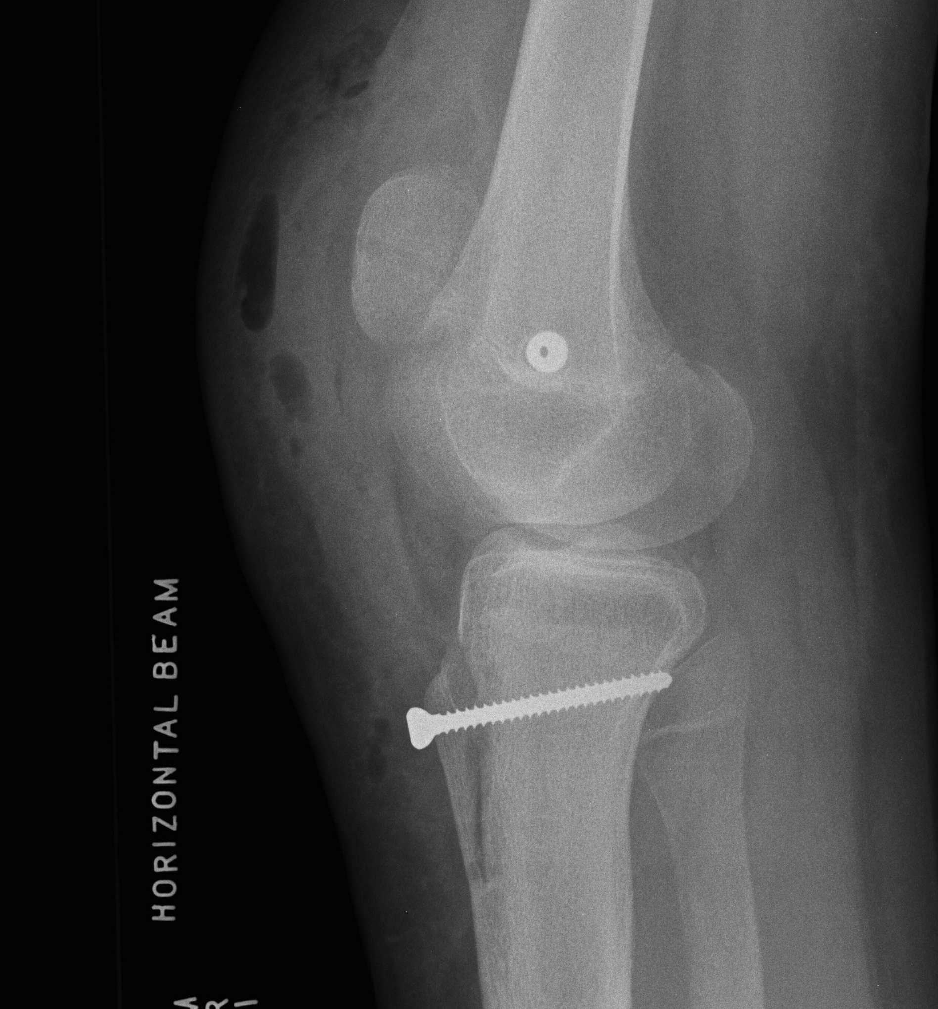 Patella Instability MPFL and TTT AP